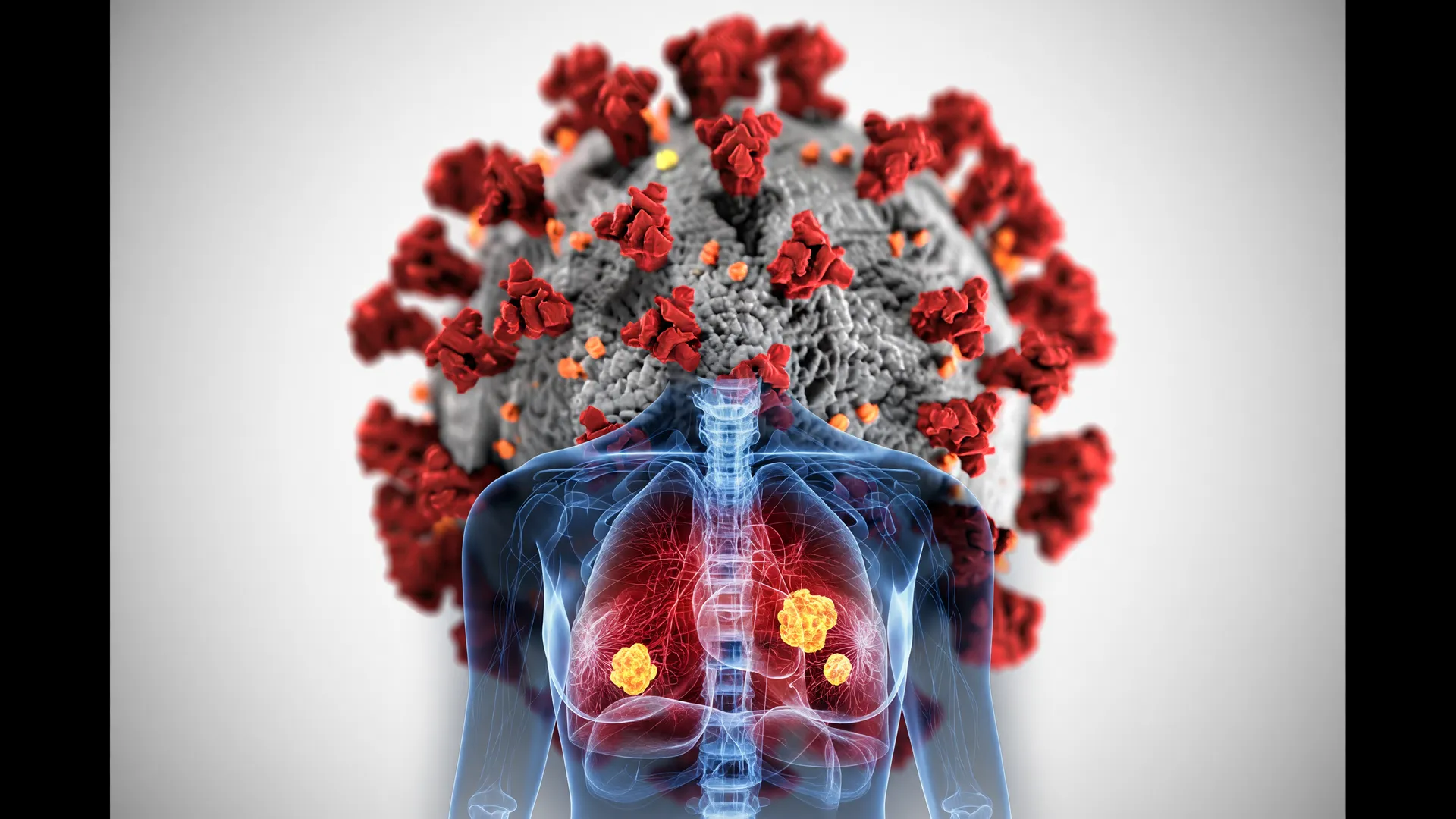 O vírus SARS-CoV-2 e representação de tumor de pulmão, ilustrando o risco de câncer de pulmão após Covid grave