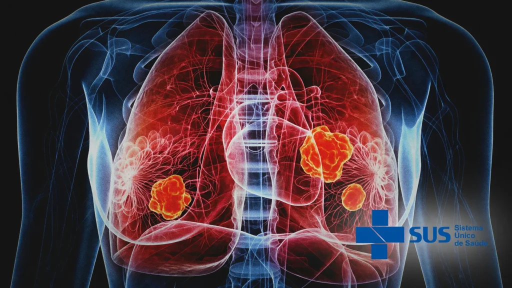 Imagem 3D de tumores pulmonares ilustra o diagnóstico tardio câncer de pulmão no Brasil